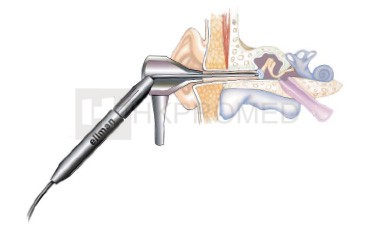 射頻鼓膜切開術輔助裝置